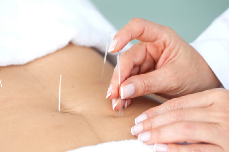 acupuncture to lose belly weight