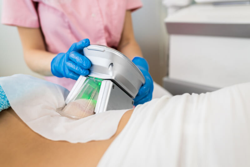 cellulite et cryolipolyse